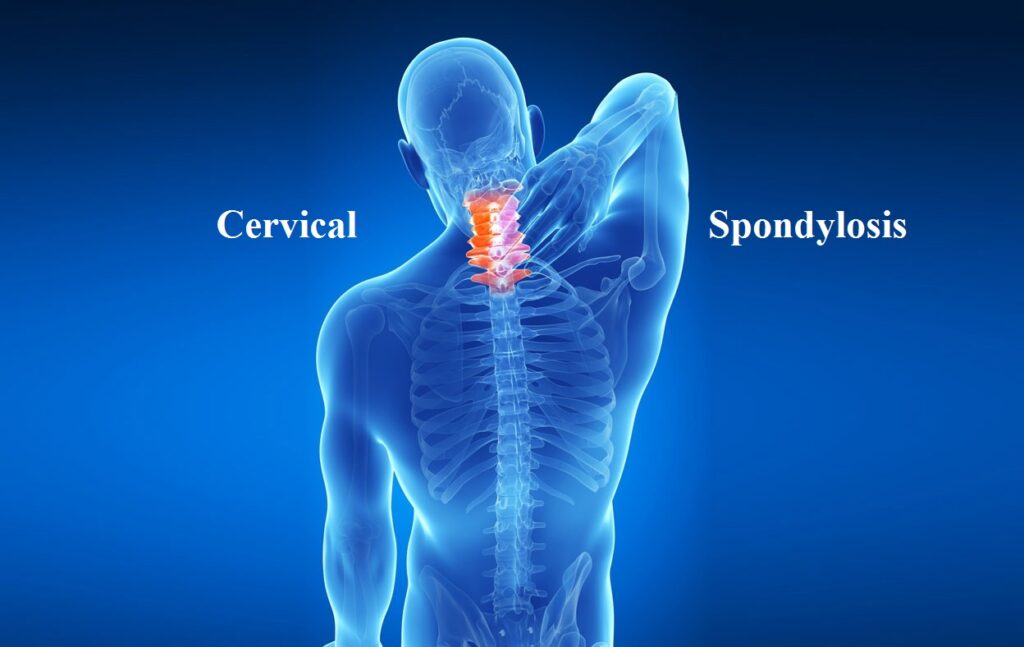 cervical spondylosis Ayurvedic treatment
